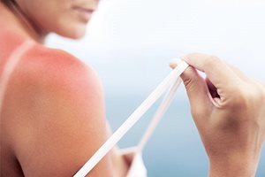 sprucken och irriterad hud