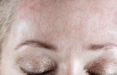 Kvinna med fjällande panna